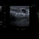 Breast carcinoma, big, lymph node: US - Ultrasound